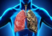 1,2 milioane de decese prin cancer pulmonar ar putea fi evitate