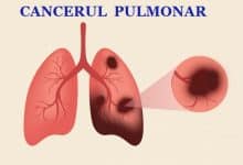 Cercetătorii din China dezvoltă un senzor care detectează cancerul pulmonar cu o precizie remarcabilă